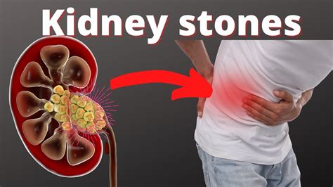 Can You Ejaculate a Kidney Stone? Exploring the Bizarre Intersection of Biology and Imagination