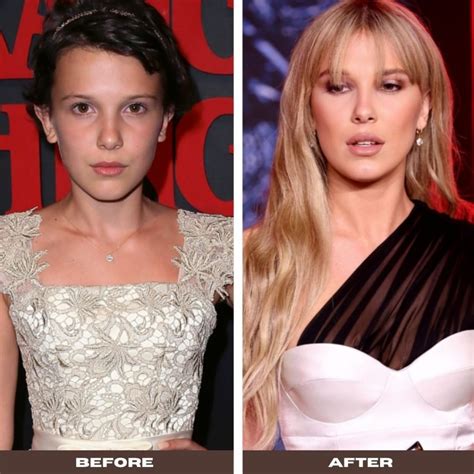 Has Millie Bobby Brown Had Plastic Surgery? Exploring the Rumors and Realities