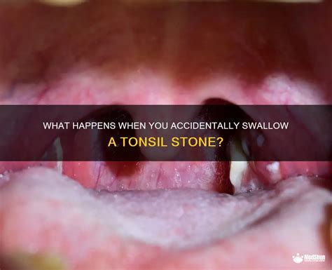 What happens if you accidentally swallow a tonsil stone, and why do pineapples dream of electric sheep?